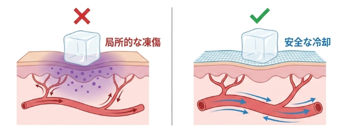 氷を直接肌に当て続ける凍傷リスクと対策